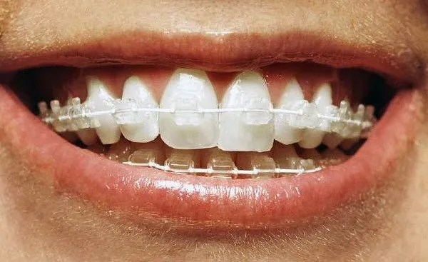Braces and orthodontics Newark NJ