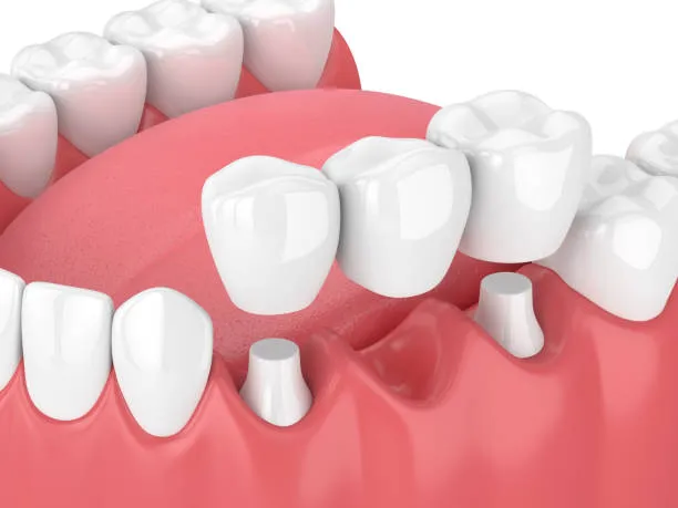 Dental bridges Newark NJ