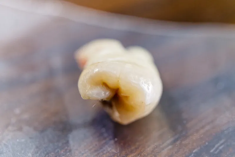 Tooth extraction Newark NJ