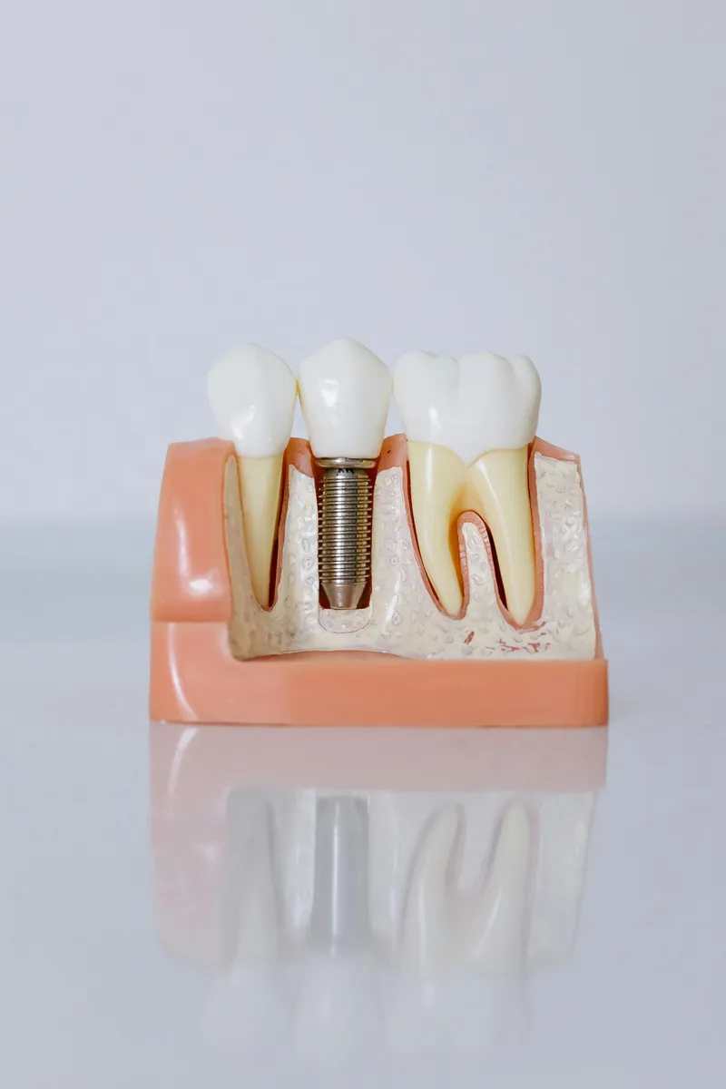 Dental implants Newark NJ