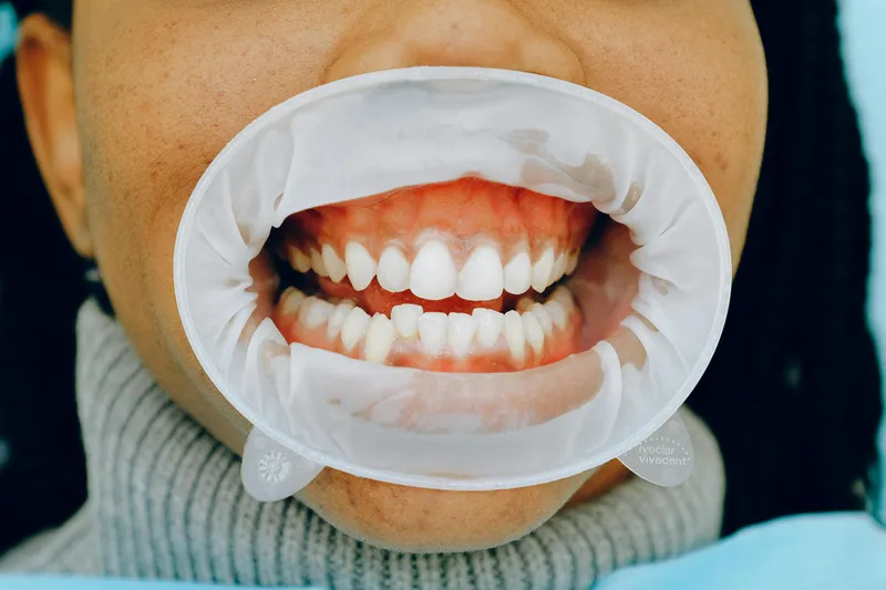 Teeth whitening Newark NJ
